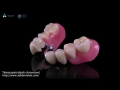 تلسکوپ Co-Cr داخلی و Co-Cr خارجی فلزی با کامپوزیت