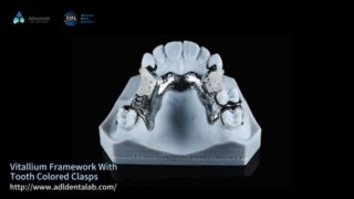 Vitalium Framework Natural Esthetics Easy Fit