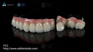روکش دندان PFZ استحکام طبیعی و تناسب دقیق