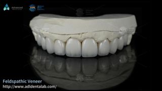روکش های سرامیکی فلدسپاتیک با شفافیت بالا برای لبخند