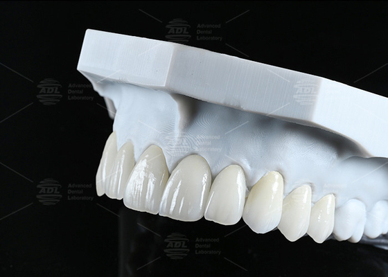 بازسازی سرامیکی شفاف CAD EMAX Veneer Polished Glazed برای مناطق جلو و عقب