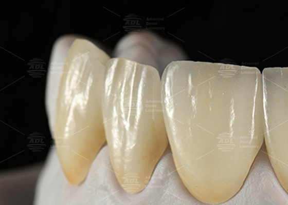 0.3mm-0.7mm فلدپاتیک EMAX فرنیر سرامیکی طبیعی زیبایی Emax فرنیر دندان
