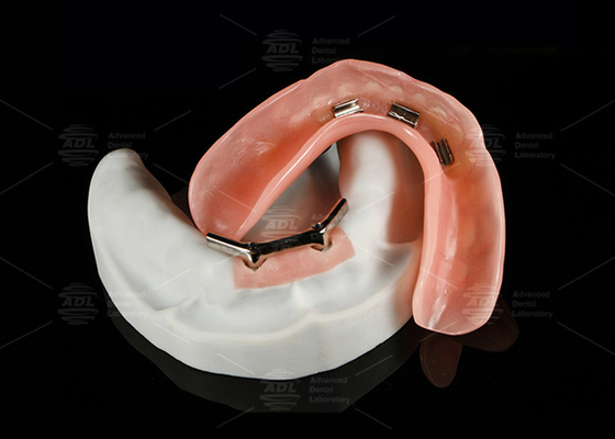 آلیاژ تیتانیوم Snap On Dolder Implant Bar Overdenture پولیش شده برای لبخند طبیعی
