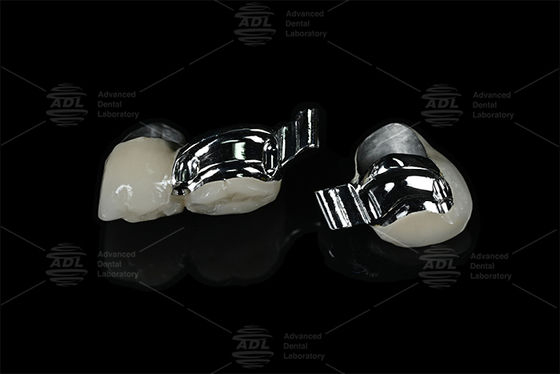 China Dental Lab Adjustable Patient Specific Keyway Precision Attachment with PFM