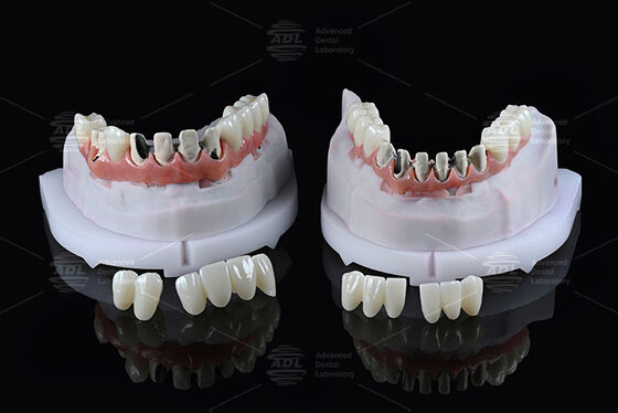 چین آزمایشگاه دندانپزشکی تیتانیوم پل هیبریدی کامل قوس با بارگذاری فوری A1 سایه Malong طراحی پیچ نگه داشته شده Cad / Cam