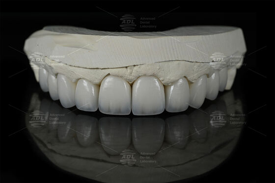 0.3mm-0.7mm فلدپاتیک EMAX فرنیر سرامیکی طبیعی زیبایی Emax فرنیر دندان